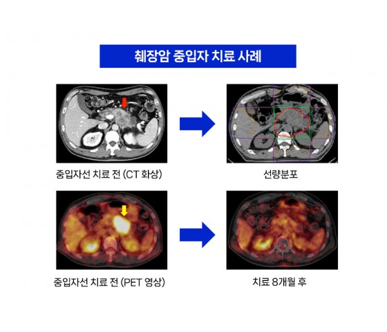 [한국미디어뉴스통신]'중입자 치료로 암 치료 정복에 한 발짝 다가선다'